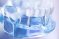 Dentsts dental tooth implant Royalty Free Stock Photo