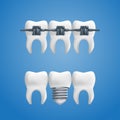 Denture concept - healthy teeth with a dental implant and braces on top of them. Vector illustration of human teeth in a 3d