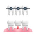 Denture concept - healthy teeth with a fixed dental bridgework and braces on top of them. Vector illustration of human teeth in a