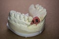 Denture impression made of plaster with implants Royalty Free Stock Photo