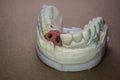 Denture impression made of plaster with implants Royalty Free Stock Photo