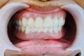 The denture