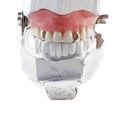 Denture with two gold teeth