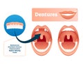 Dentures vector illustration. Medical prosthetic device for missing teeth.