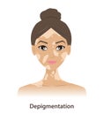 Depigmentation and white patches on woman face vector isolated on white background.