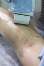 Depilation spa procedure. Woman hair remove waxing. Epilation sugaring. Legs foot With Wax Melter