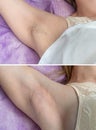 Depilation zone underarms. Close up photo before and after.