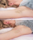 Depilation zone underarms. Before and after. Laser waxing and sugaring