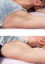 Depilation zone underarms. Before and after. Laser waxing and sugaring