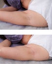 Depilation zone underarms. Before and after. Laser waxing and sugaring