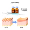 Dermal filler. Fillers injected into the skin to help fill in facial wrinkles Royalty Free Stock Photo