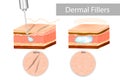 Dermal fillers or `soft-tissue fillers` Royalty Free Stock Photo