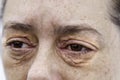 Dermatitis and allergy in eyes