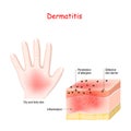 Dermatitis. Atopic eczema. Close-up of Cross-section of human skin with dermatitis