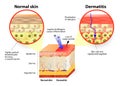 Dermatitis or eczema