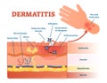 Dermatitis flat vector illustration diagram with skin layers and allergen movement. Educational medical information.