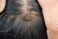 Dermatitis in hair or Skin disease on the head Royalty Free Stock Photo