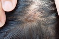 Dermatitis in hair or Skin disease on the head Royalty Free Stock Photo