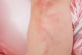 Dermatitis Herpetiformis skin rash in a woman with Nonceliac Gluten Sensitivity. Serum antibodies positive to wheat and