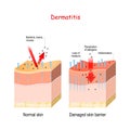 Dermatitis. Normal and skin with Damaged barrier. protection effect Royalty Free Stock Photo
