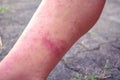 Dermatitis and vesicles, dermatitis from measles virus, dermatitis due to urticaria, health problems, allergies, redness on the le