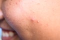 Dermatological disease acne pimples on the face of a teen boy Royalty Free Stock Photo