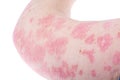 Dermatological skin disease psoriasis, more pronounced on elbow, hand. Redness and dry patches, allergic rash dermatitis Royalty Free Stock Photo