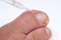 dermatologist, dermatovenereologist, podologist treats damaged rude nail on big toe of female foot, exfoliation, nail fungus,