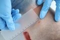 Dermatologist doctor examine patient mole in dermatology clinic