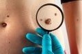 Birthmark. Dermatologist examines mole.