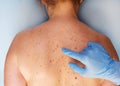 Dermatologist examining the patient in the clinic. Problem skin with a mole on the back. Closeup view.