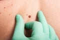 Dermatologist hand inspecting skin mole Royalty Free Stock Photo
