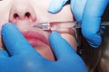 Dermatologist performs contour plastic in the lips