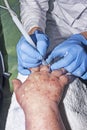 Dermatologist surgeon removes skin diseases with electrocoagula Royalty Free Stock Photo