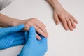 Dermatologist wearing blue gloves examines hand of child with many viral warts Verruca vulgaris, close-up