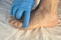 dermatologist's hand points to a wart on the foot Royalty Free Stock Photo