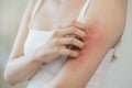 Dermatology, asian young woman, girl allergy, allergic reaction from atopic, insect bites on her arm, hand in scratching itchy, Royalty Free Stock Photo