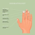 Dermatology. Nail deseases. Nail clubbing, paronychia, onycholusis, anonuchia, micronychia