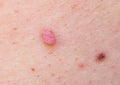 Large papilloma and a mole on the skin of the armpit. Human Papilloma Virus. Royalty Free Stock Photo