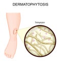 Dermatophytosis. Ringworm on a human leg