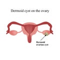 Dermoid cyst on the ovary.