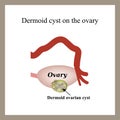 Dermoid cyst on the ovary. Ovary. Infographics.