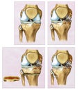 Descriptive illustration an Osteotomy or correction of the knee where the femur and tibia appear crooked.