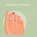 Deseases of toenails vector medicine card. Colorful design. Detailed image with text.