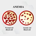 Anemia amount of red blood Iron deficiency anemia difference of Anemia amount of red blood cell and normal symptoms vector illustr