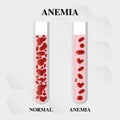 Anemia amount of red blood Iron deficiency anemia difference of Anemia amount of red blood cell and normal symptoms vector illustr