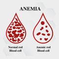 Anemia amount of red blood Iron deficiency anemia difference of Anemia amount of red blood cell and normal symptoms vector illustr