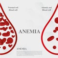 Anemia amount of red blood Iron deficiency anemia difference of Anemia amount of red blood cell and normal symptoms vector illustr