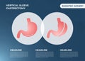 Laparoscopic Sleeve Gastrectomy, Vertical Gastrectomy, Weight loss surgery Vector Illustration of Stomach reduction surgery