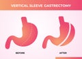 Laparoscopic Sleeve Gastrectomy, Vertical Gastrectomy, Weight loss surgery Vector Illustration of Stomach reduction surgery